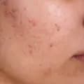 ForTheLoveOfPimples-fortheloveofpimples